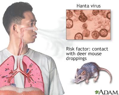 Does China Have a ‘New’ Outbreak of Hantavirus?