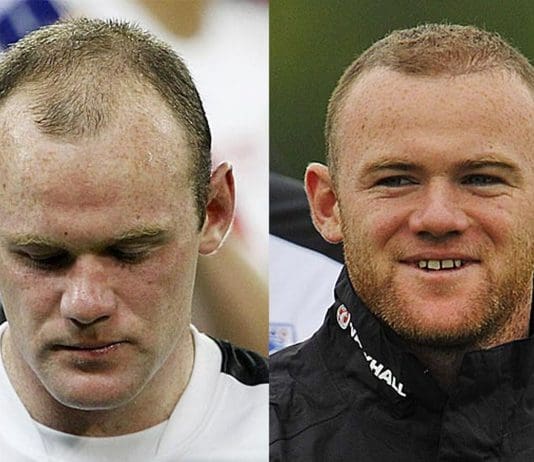 some famous people with hair transplants