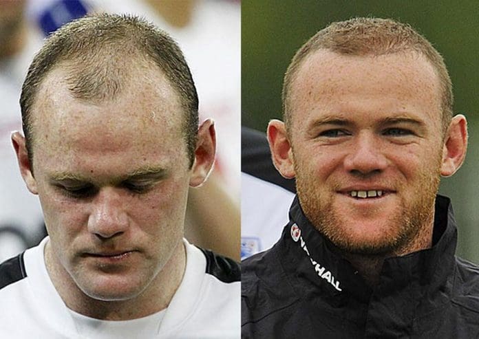 some famous people with hair transplants