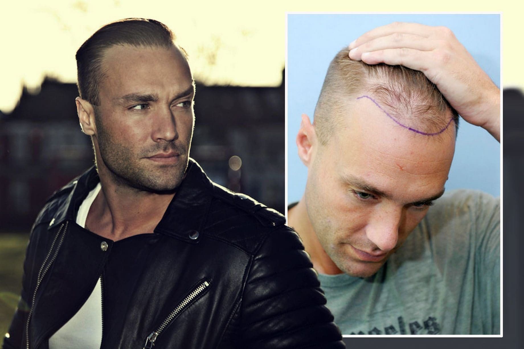 famous people with hair transplants