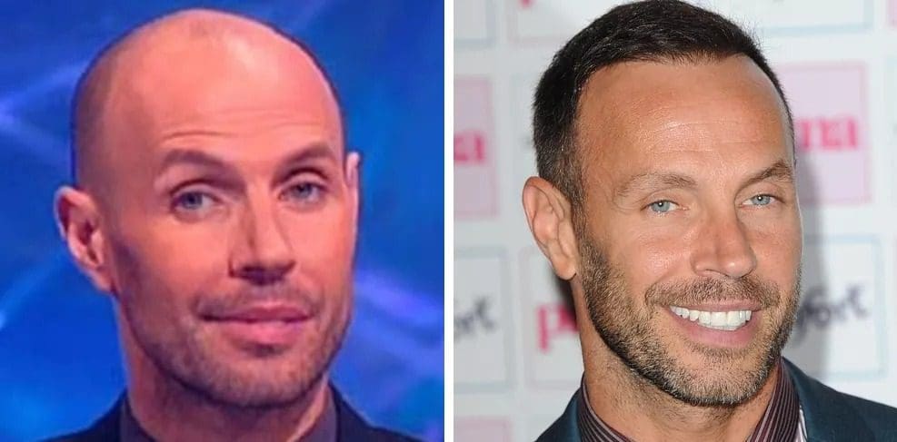 Some Famous People With Hair Transplants: Louis Walsh, Joe Swash, and More! 8 famous people with hair transplants