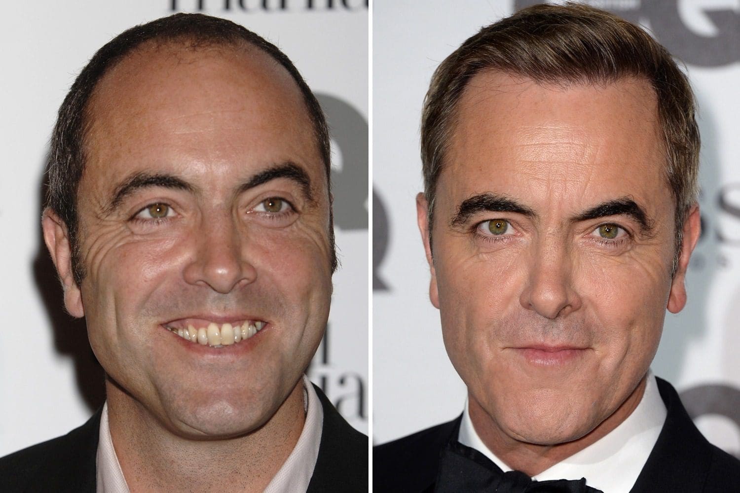 famous people with hair transplants