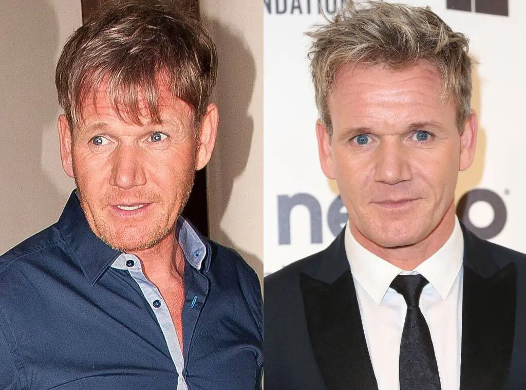 Some Famous People With Hair Transplants: Louis Walsh, Joe Swash, and More! 7 famous people with hair transplants