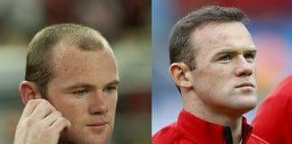 famous people with hair transplants
