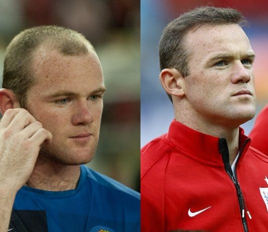 famous people with hair transplants
