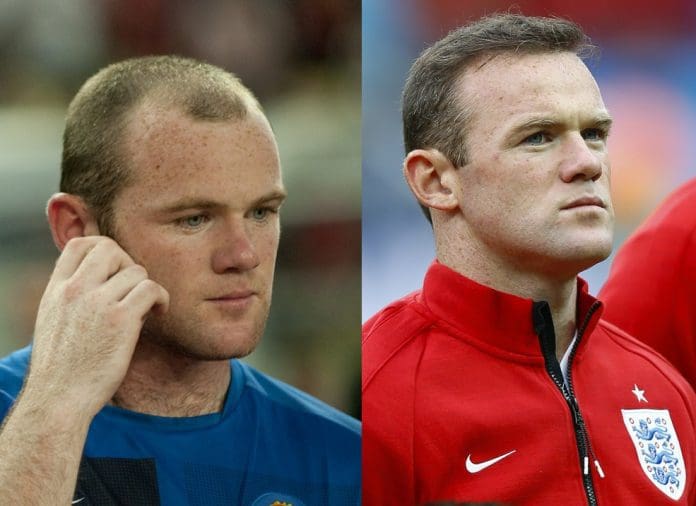 famous people with hair transplants